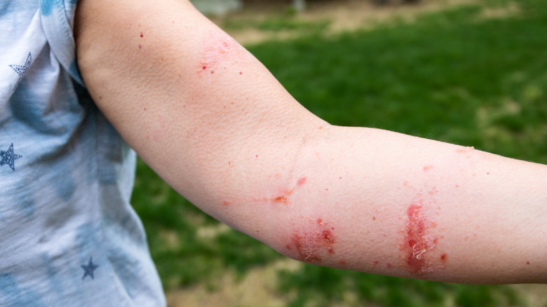 poison ivy rash on arm
