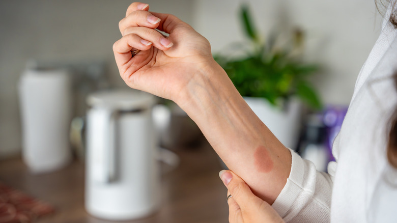 Person with burn mark on arm.